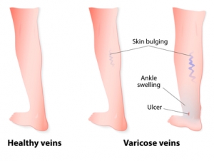 Venous Ulcers Treatment Advanced Wound Care Plano Tx - Dr. Hina Rizvi M 